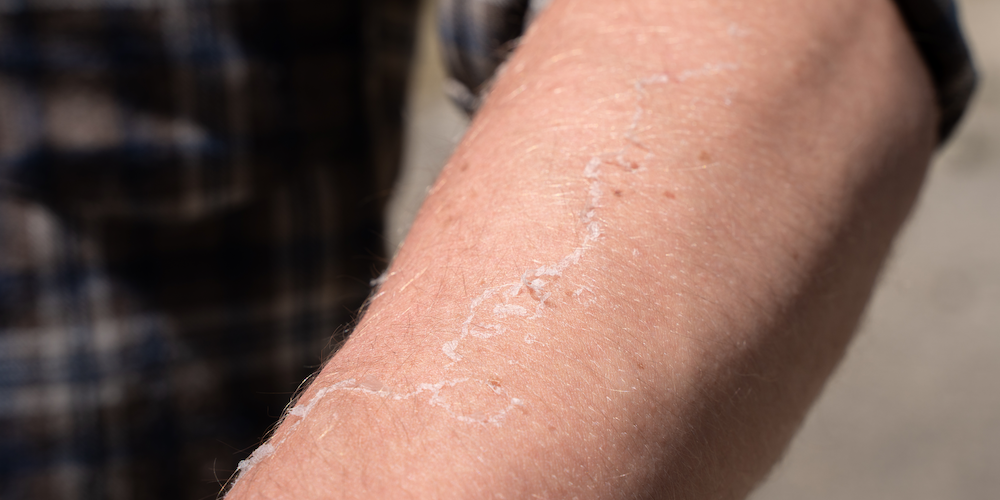 Dermatology Appointment for Dry, Flaky Skin and Possible Psoriasis in Vienna, Virginia