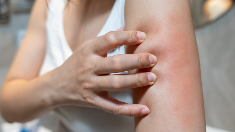 Dermatology Appointment for Circular Rash or Possible Ringworm in Falls Church, Virginia