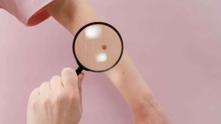 Dermatologist Near Vienna, Virginia for a Suspicious Freckle or Skin Growth