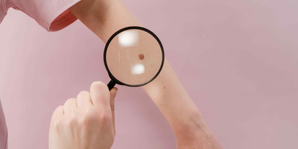 Dermatologist Near Vienna, Virginia for a Suspicious Freckle or Skin Growth