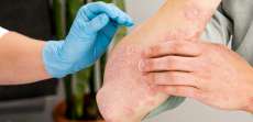 Psoriasis Flare Up Treatment Near Falls Church, Virginia: Urgent Care Appointment