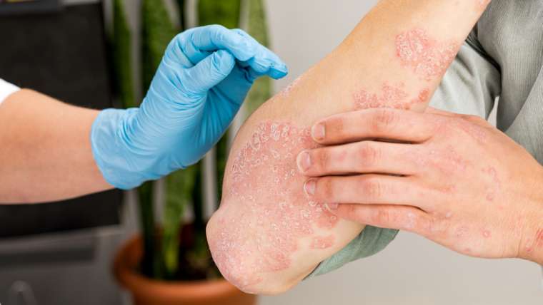 Psoriasis Flare Up Treatment Near Falls Church, Virginia: Urgent Care Appointment