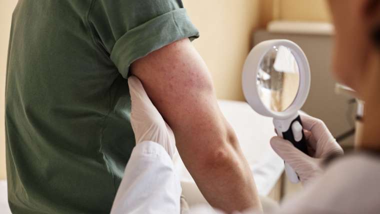 Psoriasis Specialist Near Falls Church, Virginia: Best Treatment Options
