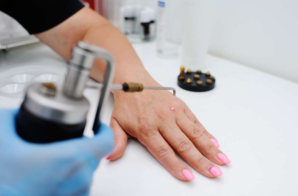 Dermatologist Appointment for Wart Removal Near Falls Church, Virginia