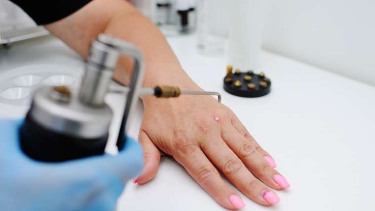 Dermatologist Appointment for Wart Removal Near Falls Church, Virginia