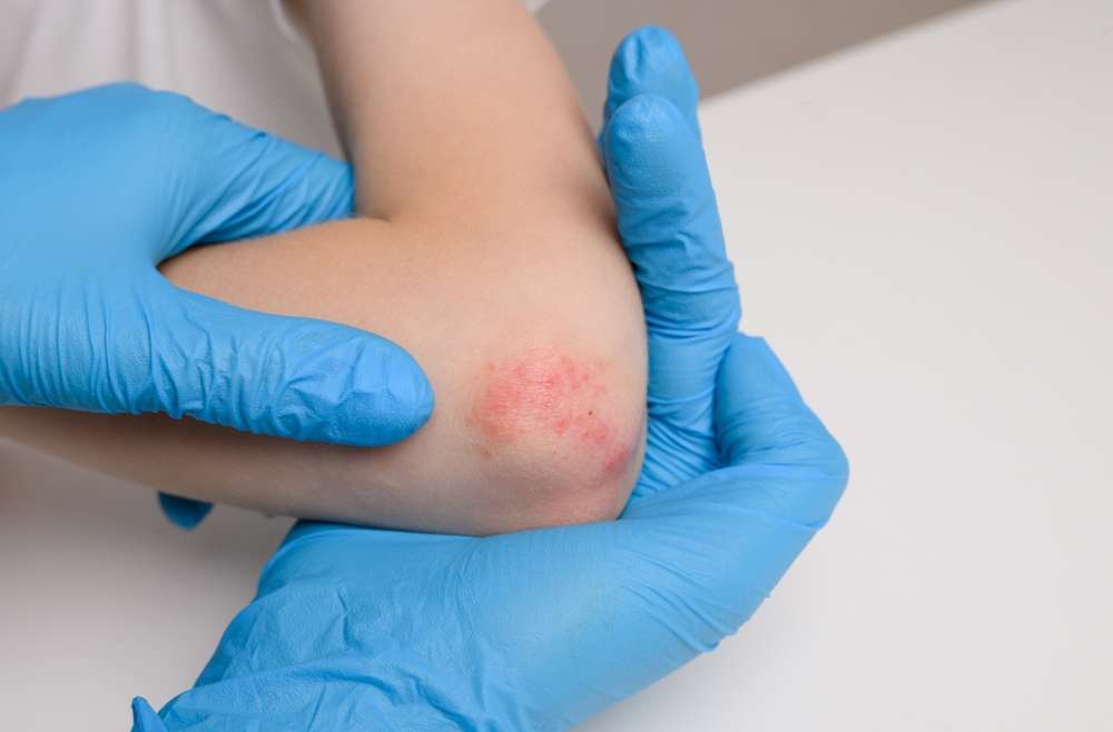 When to See the Best Eczema Treatment Specialists for Chronic Dry and Itchy Skin Relief