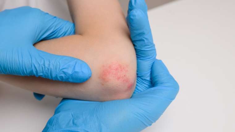 When to See the Best Eczema Treatment Specialists for Chronic Dry and Itchy Skin Relief