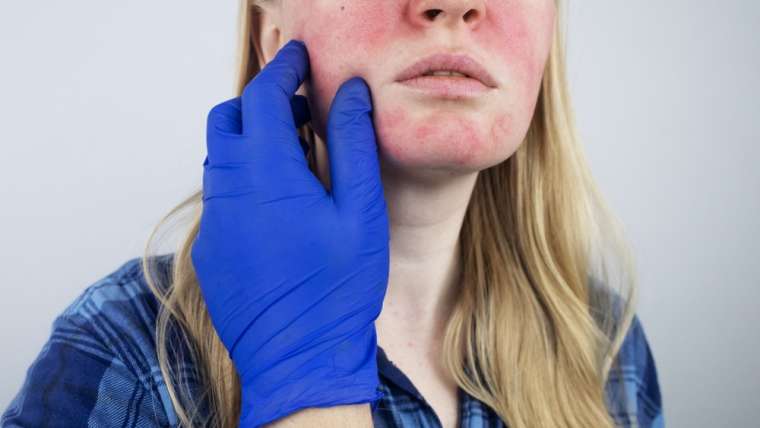 When to See the Best Rosacea Specialist in Arlington, VA, for Facial Redness and Sensitive Skin Treatments (And How to Find Them!)