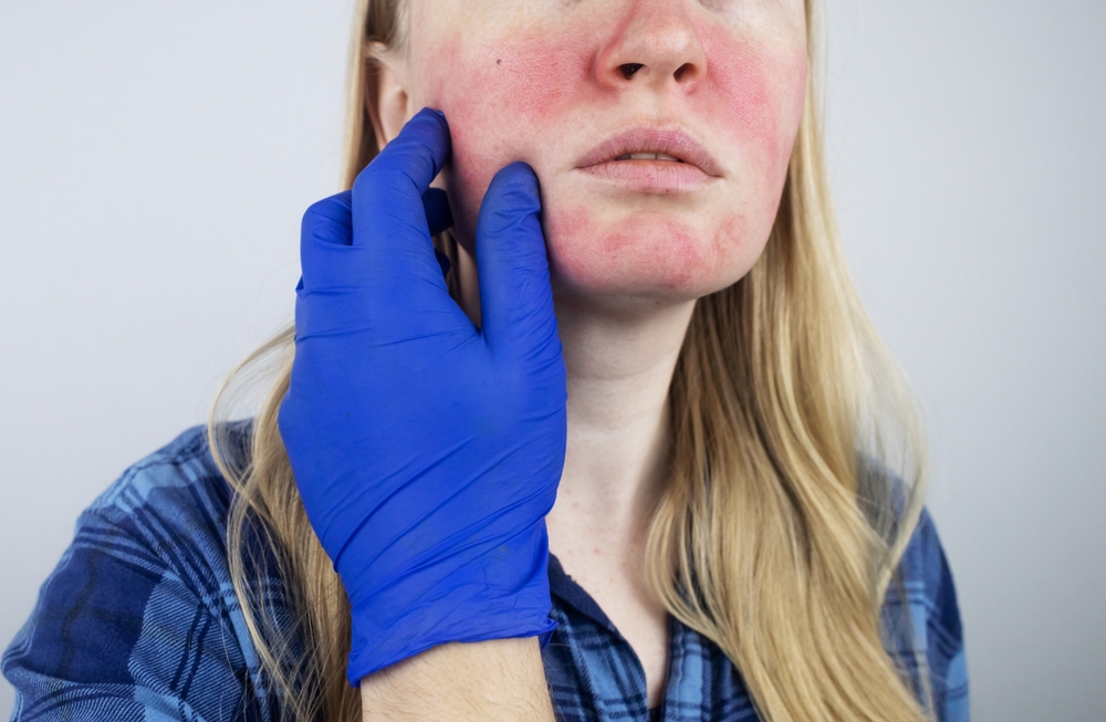 When to See the Best Rosacea Specialist in Arlington, VA, for Facial Redness and Sensitive Skin Treatments (And How to Find Them!)