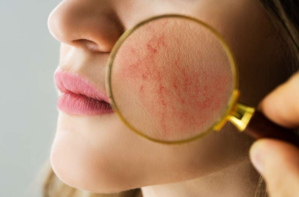 What to Expect When Meeting With the Best Rosacea Specialist in Vienna, VA, for Advanced Rosacea Care and Laser Treatments?