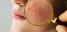 What to Expect When Meeting With the Best Rosacea Specialist in Vienna, VA, for Advanced Rosacea Care and Laser Treatments?
