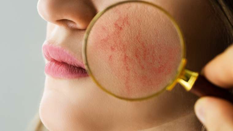 What to Expect When Meeting With the Best Rosacea Specialist in Vienna, VA, for Advanced Rosacea Care and Laser Treatments?