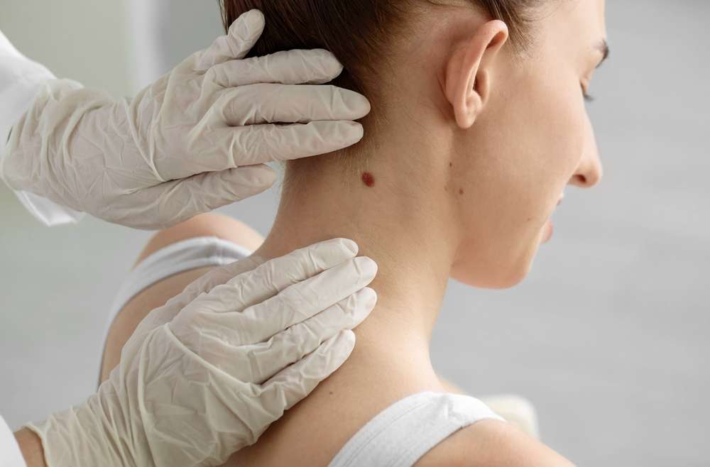 Changes in a Mole? Why McLean, VA Residents Should Schedule a Skin Cancer Check