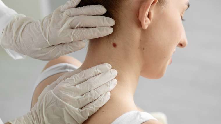Changes in a Mole? Why McLean, VA Residents Should Schedule a Skin Cancer Check