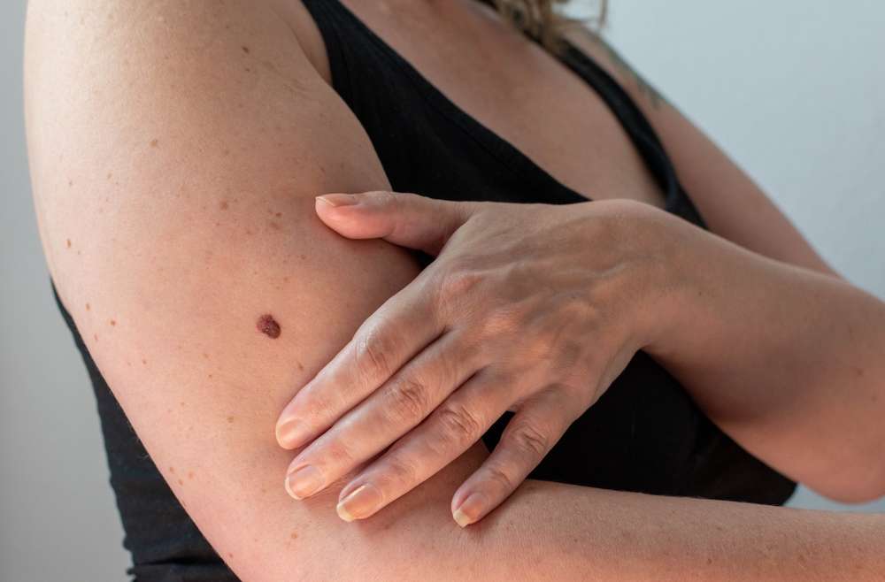 Warning Signs of Skin Cancer Near Falls Church, VA: When a Spot Should Be Evaluated by a Dermatologist
