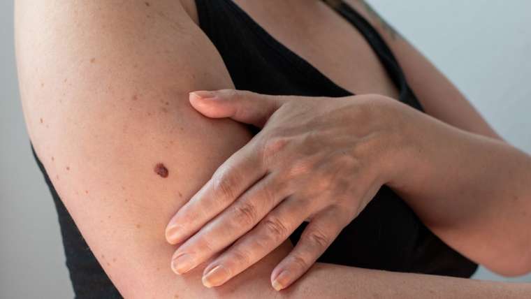 Warning Signs of Skin Cancer Near Falls Church, VA: When a Spot Should Be Evaluated by a Dermatologist
