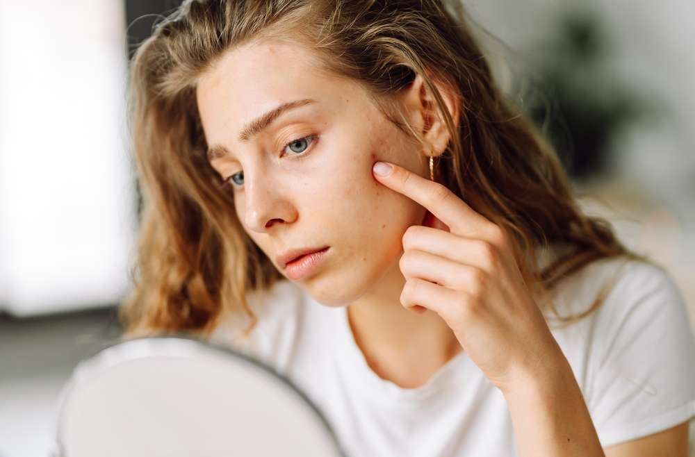 Why Do My Acne Breakouts Happen in the Same Place Every Month?