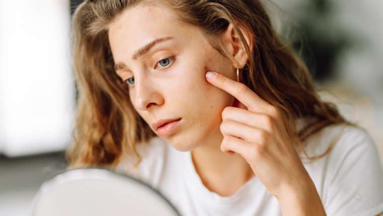 Why Do My Acne Breakouts Happen in the Same Place Every Month?