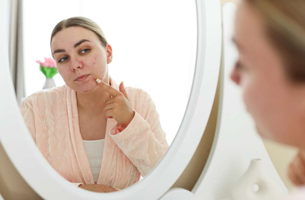 Why Am I Still Getting Acne as an Adult? (+ How to Treat It!)