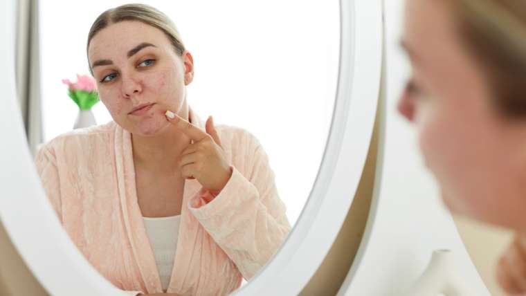 Why Am I Still Getting Acne as an Adult? (+ How to Treat It!)