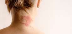 Why Did I Suddenly Develop Eczema as an Adult?