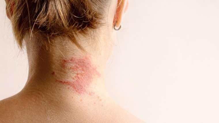Why Did I Suddenly Develop Eczema as an Adult?