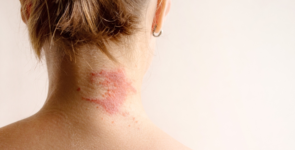 Why Did I Suddenly Develop Eczema as an Adult?