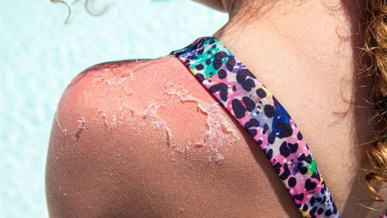 Do Childhood Sunburns Raise Skin Cancer Risk Decades Later?