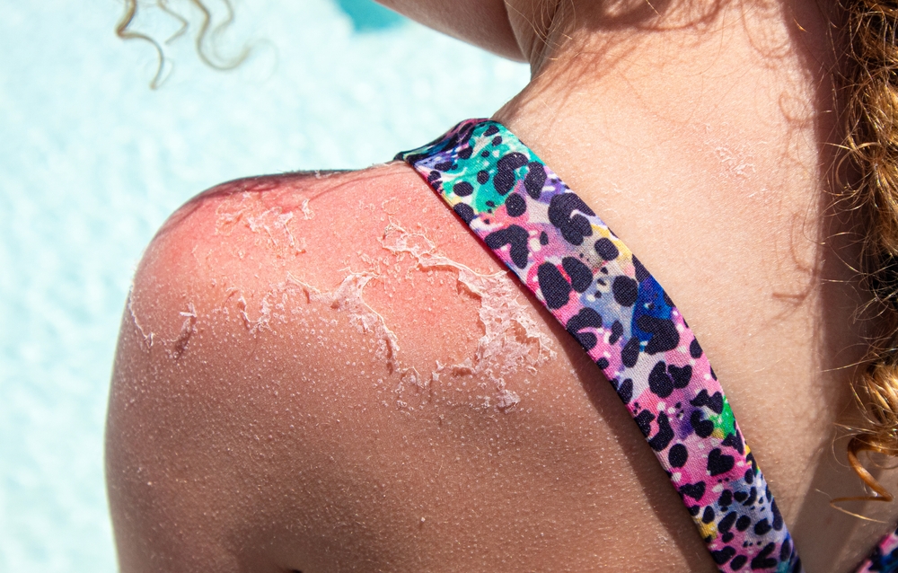 Do Childhood Sunburns Raise Skin Cancer Risk Decades Later?