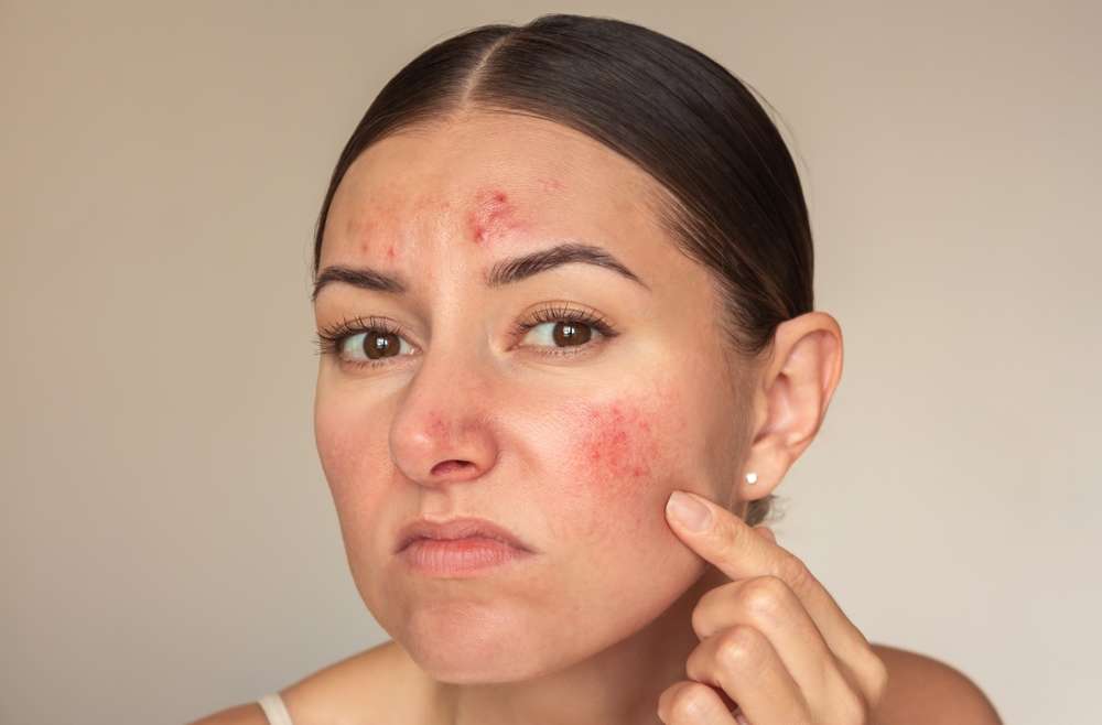 Eczema on Face in Arlington, VA: Tiggers and Treatments