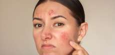 Eczema on Face in Arlington, VA: Tiggers and Treatments