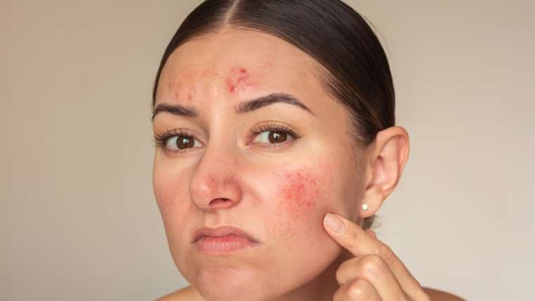Eczema on Face in Arlington, VA: Tiggers and Treatments