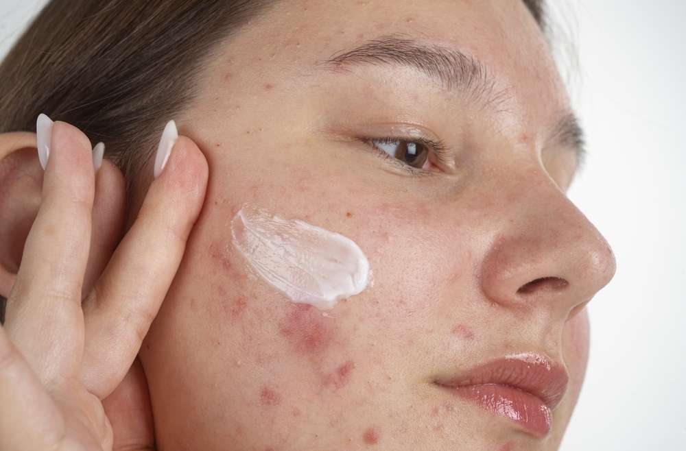 Why Acne Treatment Differs by Age and Skin Type