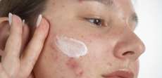Why Acne Treatment Differs by Age and Skin Type