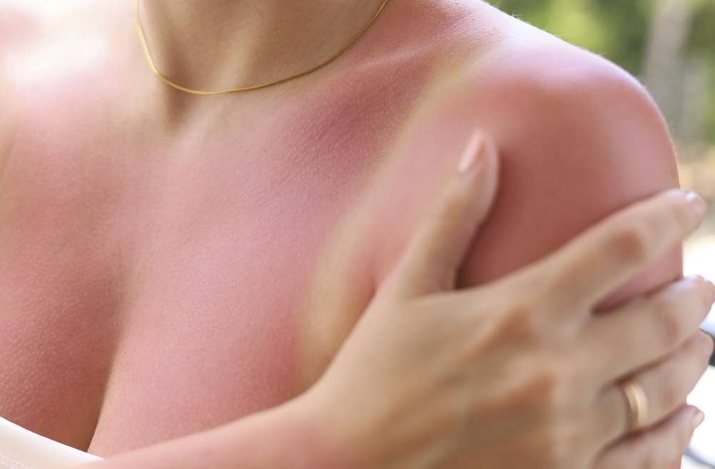 Does Fair Skin That Burns Easily Actually Raise Your Skin Cancer Risk?