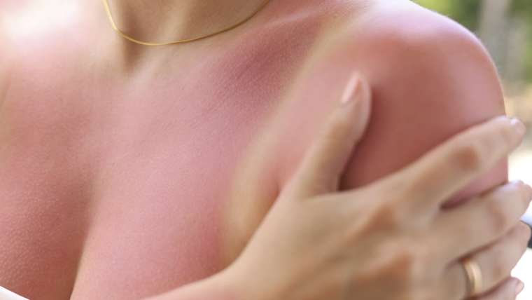 Does Fair Skin That Burns Easily Actually Raise Your Skin Cancer Risk?