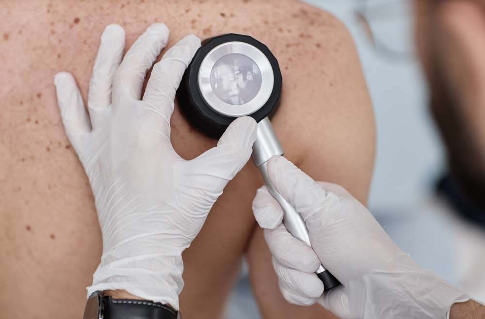 What Makes Melanoma Different from Other Skin Cancers in Vienna, VA