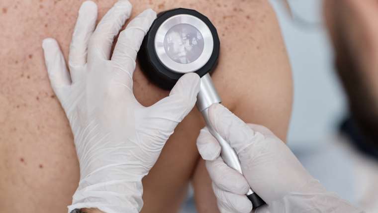 What Makes Melanoma Different from Other Skin Cancers in Vienna, VA