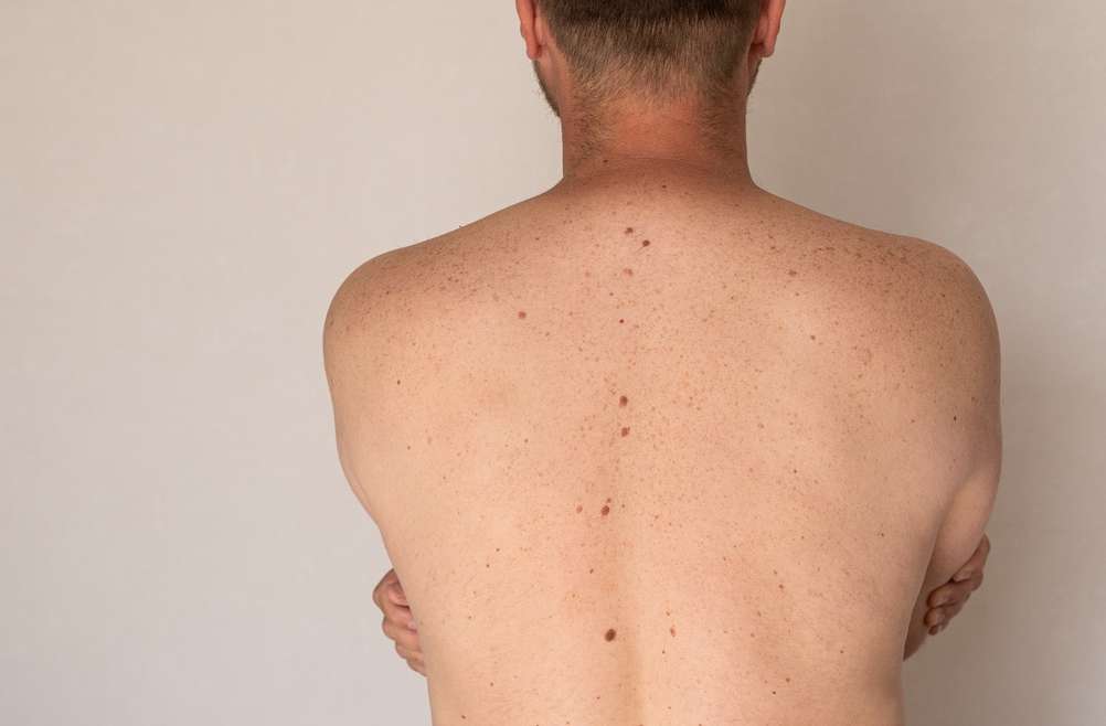 Do Multiple Moles or an Atypical Growth Actually Mean You Need a Dermatologist?