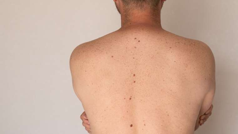 Do Multiple Moles or an Atypical Growth Actually Mean You Need a Dermatologist?